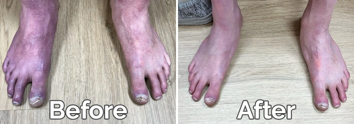 Neuropathy Davenport IA Feet Before And After Treatment